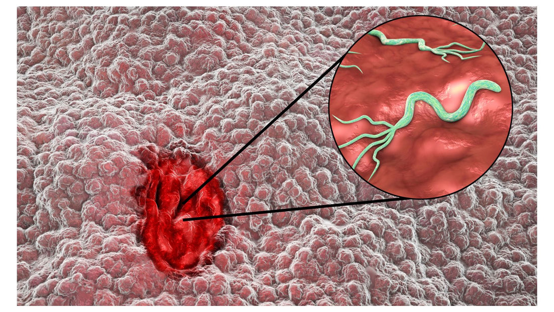 Helicobacter pylori – Bacteria ascunsă care îți atacă stomacul